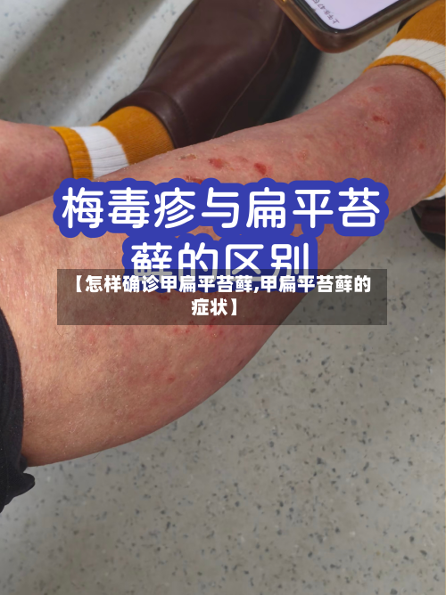 【怎样确诊甲扁平苔藓,甲扁平苔藓的症状】-第2张图片