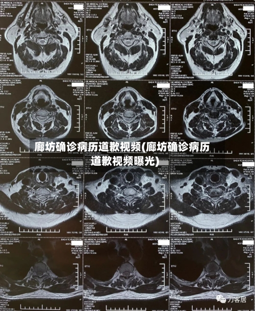 廊坊确诊病历道歉视频(廊坊确诊病历道歉视频曝光)-第3张图片