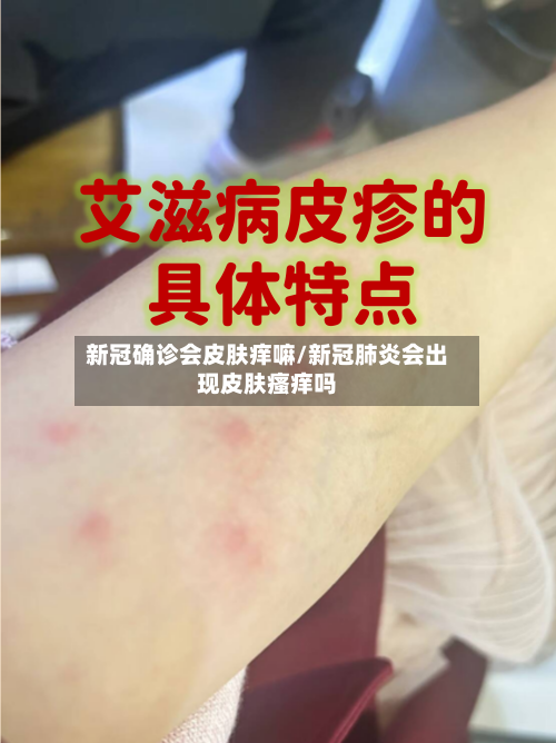 新冠确诊会皮肤痒嘛/新冠肺炎会出现皮肤瘙痒吗