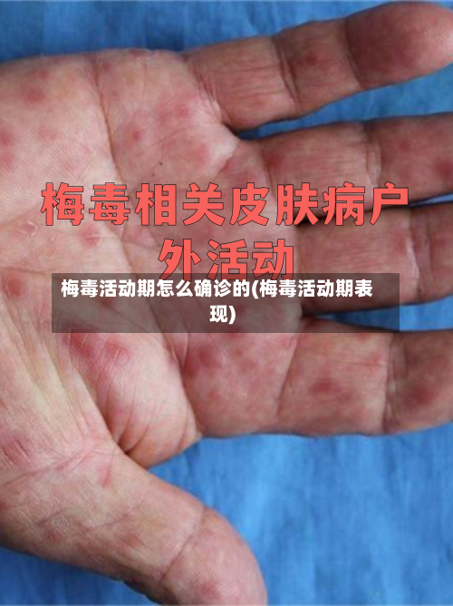 梅毒活动期怎么确诊的(梅毒活动期表现)-第2张图片