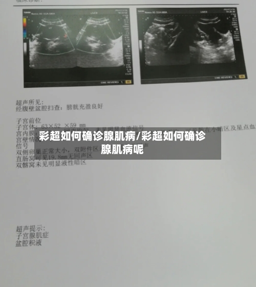 彩超如何确诊腺肌病/彩超如何确诊腺肌病呢-第3张图片