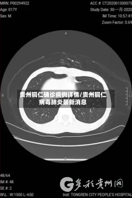 贵州铜仁确诊病例详情/贵州铜仁病毒肺炎最新消息-第2张图片