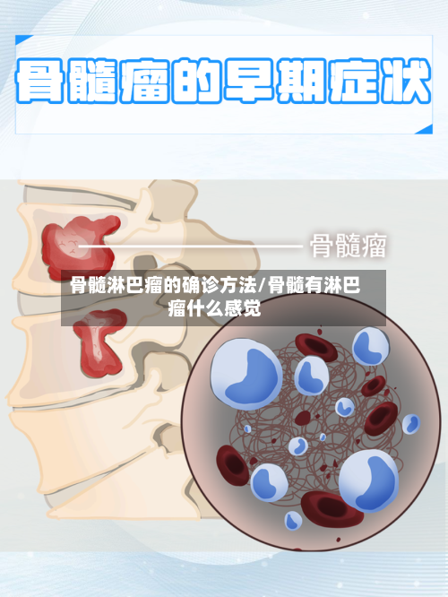 骨髓淋巴瘤的确诊方法/骨髓有淋巴瘤什么感觉-第3张图片