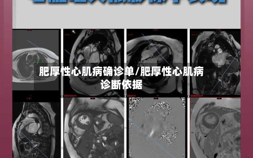 肥厚性心肌病确诊单/肥厚性心肌病诊断依据