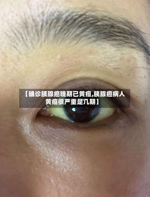 【确诊胰腺癌晚期已黄疸,胰腺癌病人黄疸很严重是几期】
