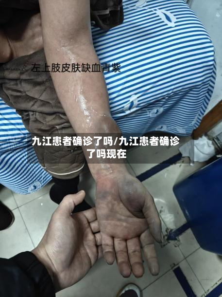 九江患者确诊了吗/九江患者确诊了吗现在-第2张图片