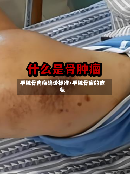 手腕骨肉瘤确诊标准/手腕骨瘤的症状-第2张图片
