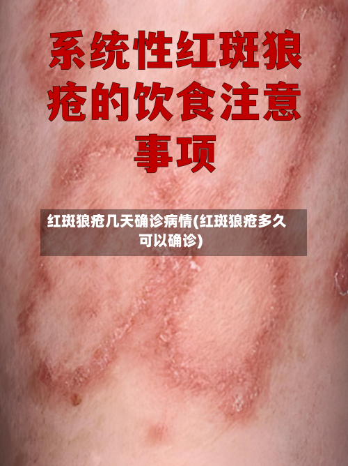 红斑狼疮几天确诊病情(红斑狼疮多久可以确诊)