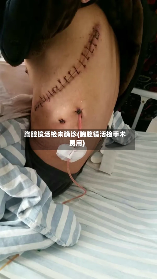 胸腔镜活检未确诊(胸腔镜活检手术费用)-第2张图片