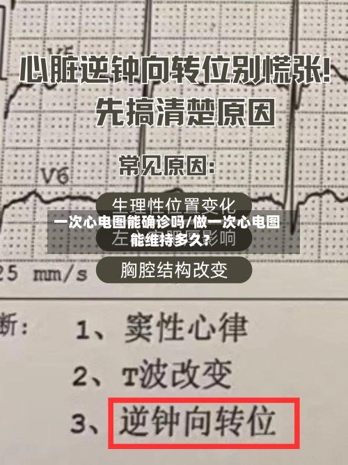 一次心电图能确诊吗/做一次心电图能维持多久?-第2张图片