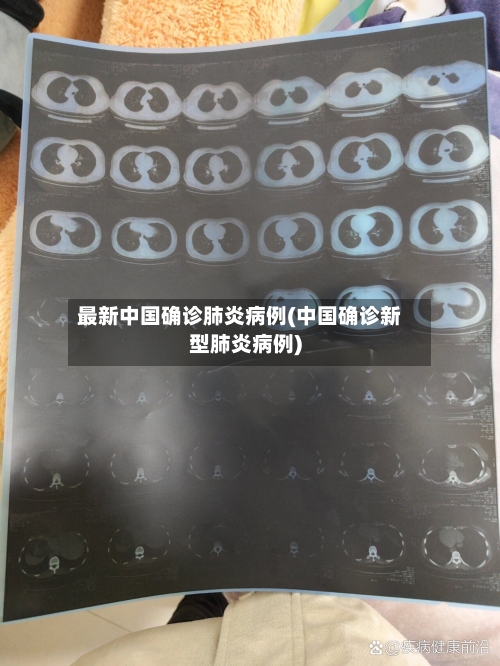 最新中国确诊肺炎病例(中国确诊新型肺炎病例)-第3张图片