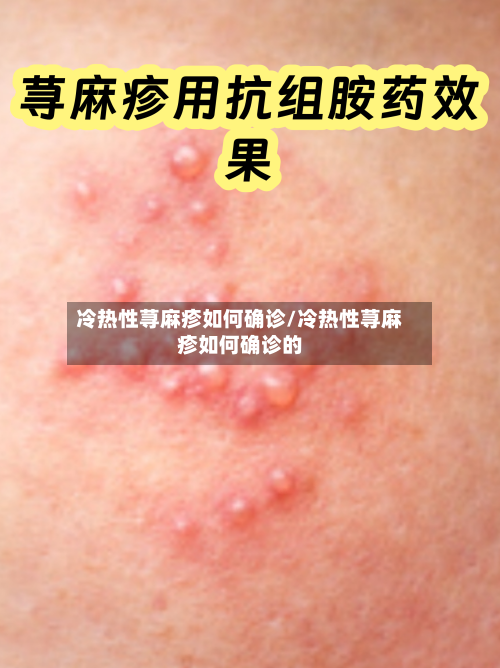 冷热性荨麻疹如何确诊/冷热性荨麻疹如何确诊的-第2张图片