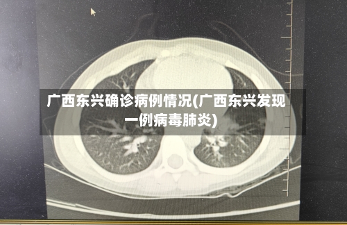 广西东兴确诊病例情况(广西东兴发现一例病毒肺炎)-第2张图片