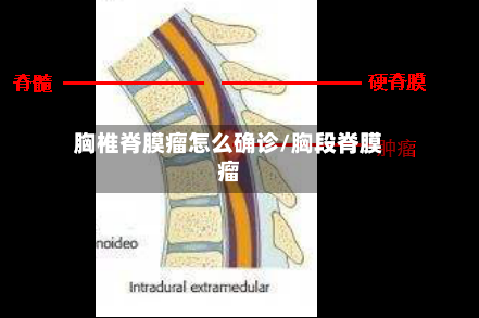 胸椎脊膜瘤怎么确诊/胸段脊膜瘤-第2张图片