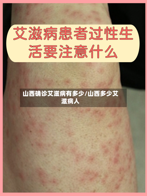 山西确诊艾滋病有多少/山西多少艾滋病人